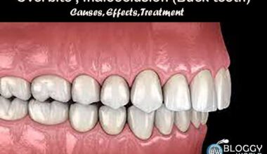 How to fix overbite adults,Severe overbite,how to fix overbite with braces,overbite surgery,how to fix overbite jaw,how to fix overbite with thumbsucking overbite, buck teeth, overbite,overbite correction,how to fix an overbite,fixing an overbite,overbite fix,overbites,overbite braces,can invisalign fix an overbite,braces overbite,big overbite,overbite vs overjet,overjet vs overbite,deep overbite,what is overjet and overbite,how to fix overbites,overbite overjet,overbite surgery,tooth overbites,overbite correction with braces,fixing overbites,overbite treatment,invisalign overbite,how do i fix my overbite, overbite,overbites,overbite correction,what's an overbite,overbite fix,overbite braces,how to fix an overbite,fixing an overbite,big overbite,deep overbite,do i have an overbite,overbite treatment,teeth overbite,what's an overjet,braces overbite,tooth overbites,overbite surgery,too much overbite,fixing overbites,causes of overbite,overjet vs overbite,overbite vs overjet,overbite solutions,how to fix overbites,invisalign overbite, overbite,overbite correction,what is overjet and overbite,how to correct an overbite,how to fix an overbite,overbites,what is a herbst appliance?,overbite correction without braces,overbite correction with braces,overbite jaw surgery,how do braces fix overbites?,overbite chin,does a herbst appliance hurt?,how overbites are fixed,what is overjet,oral hygiene and overbite,deep overbite correction,what is a herbst appliance used for?,do i have an overjet, premier orthodontics,braces,orthodontics,before and after braces,overbite,ava orthodontics,braces before and after,life with braces before and after overbite,overbites,orthodontics before and after,severe deep bite: before and after braces,best orthodontics near me,getting braces,how do braces fix overbites?,braces face change before and after,manhattan bridge orthodontics,fixing and overbite with braces,orthodontic treatment,how overbites are fixed