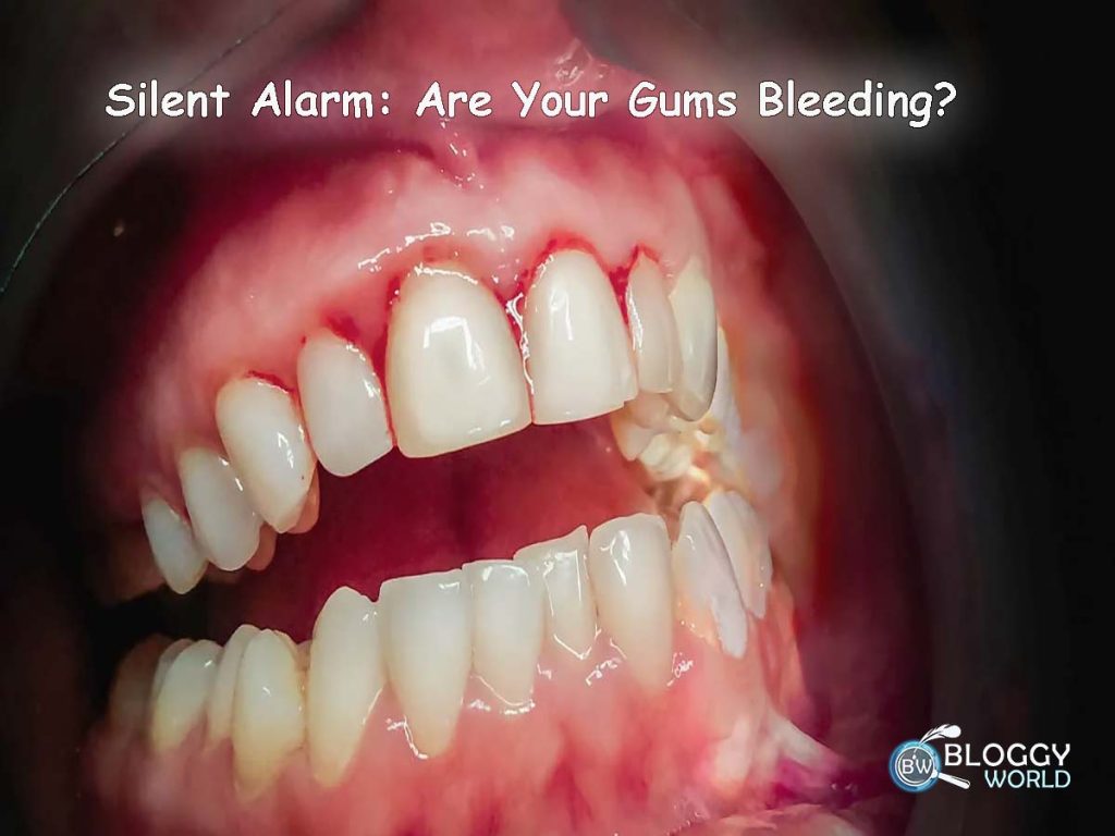 why my gums are bleeding,reasons and causes of bleeding gums why it is harmful for oral health image presented by bloggyworld.com